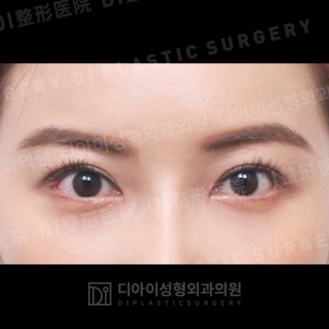 CASE 6 · After