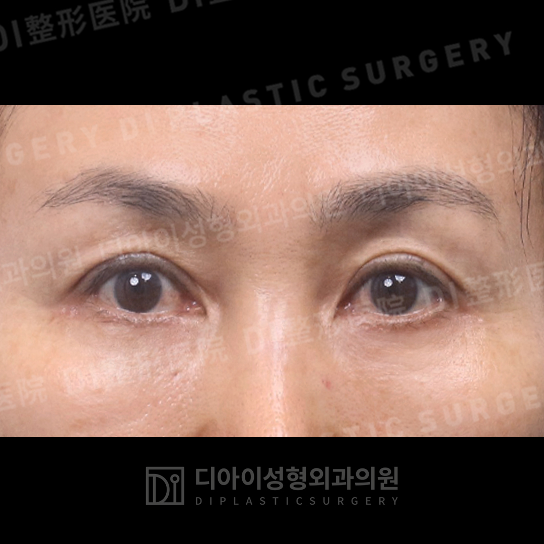 CASE 4 · After
