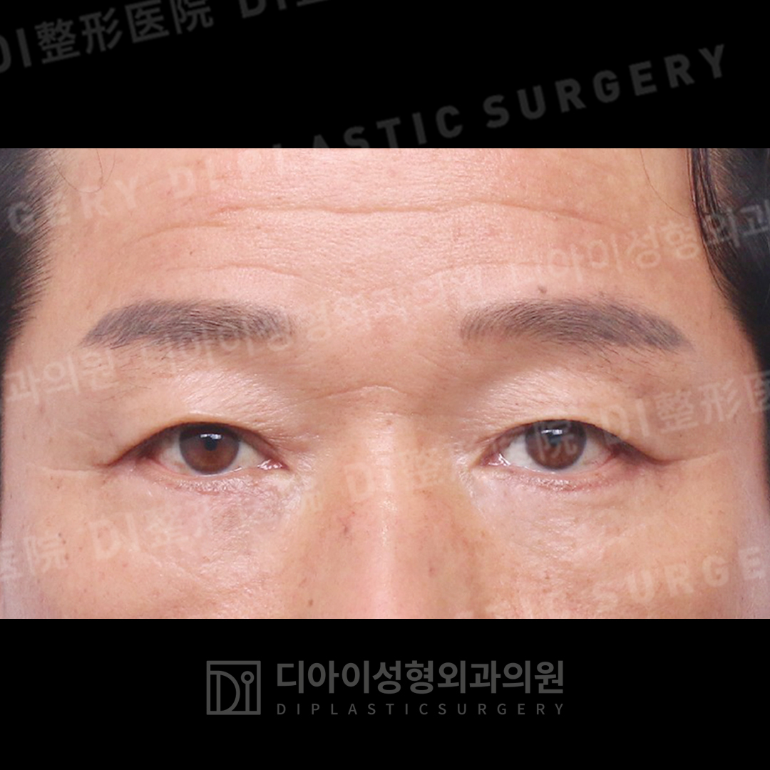 CASE 4 · After