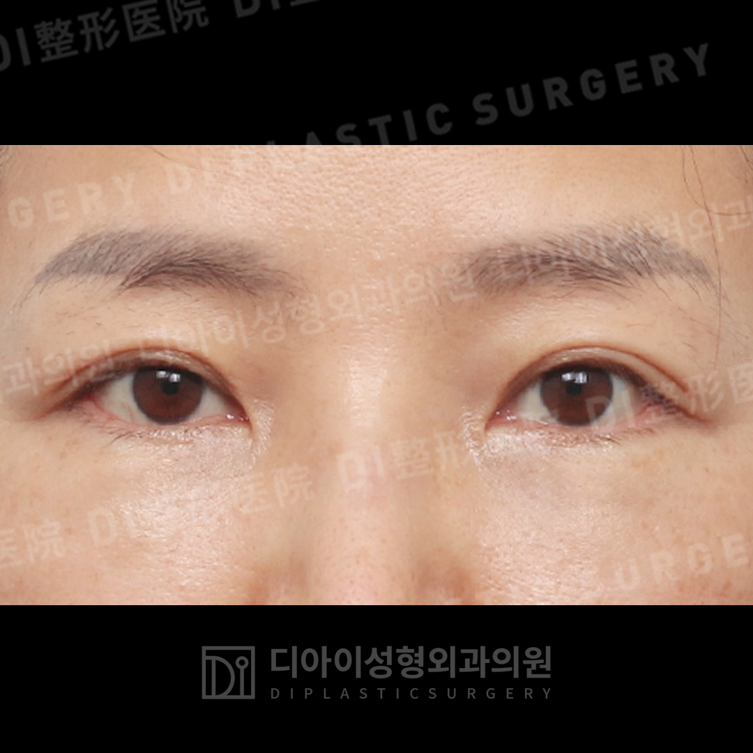 CASE 6 · After