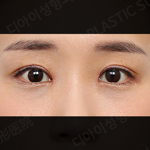 CASE 4 · After