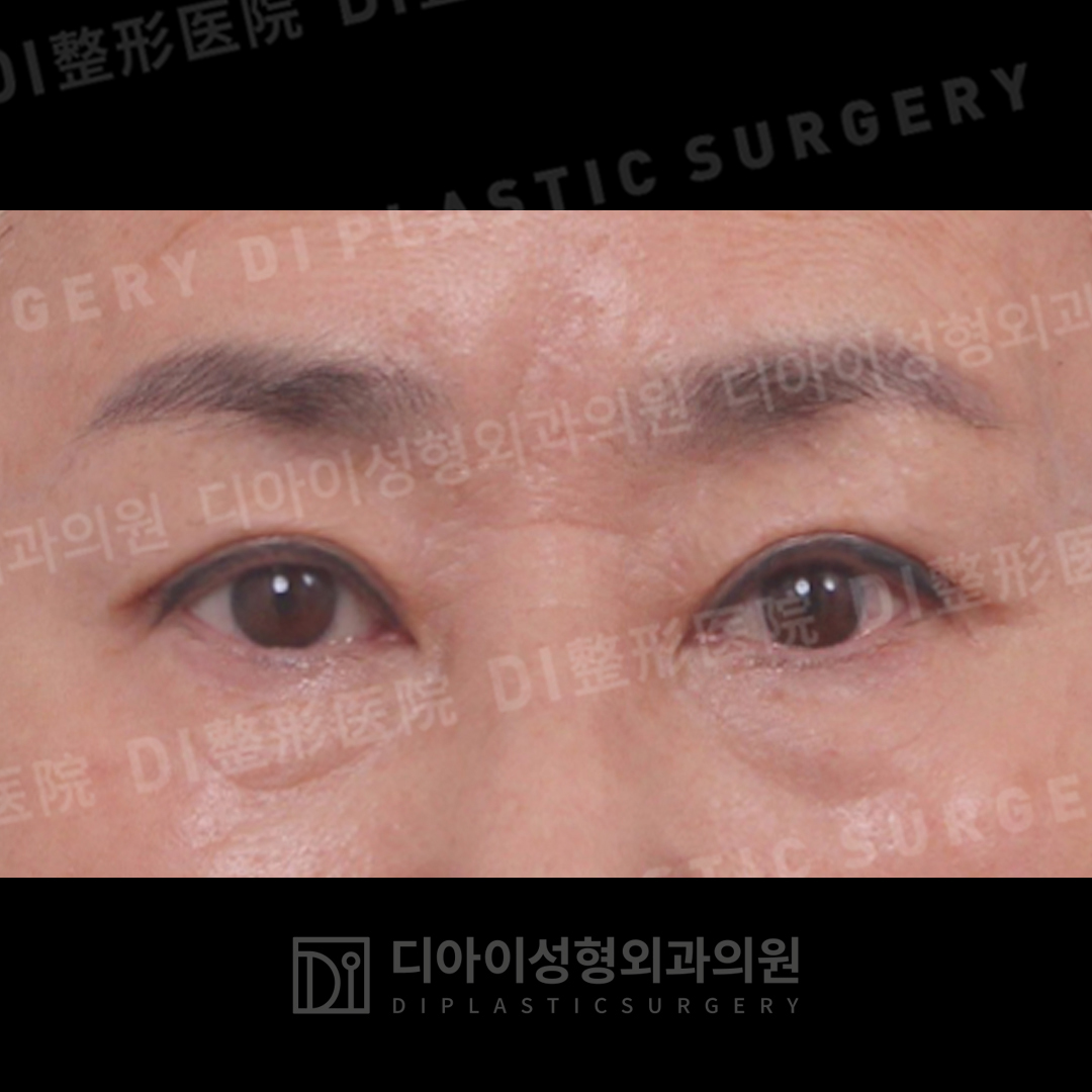 CASE 6 · After