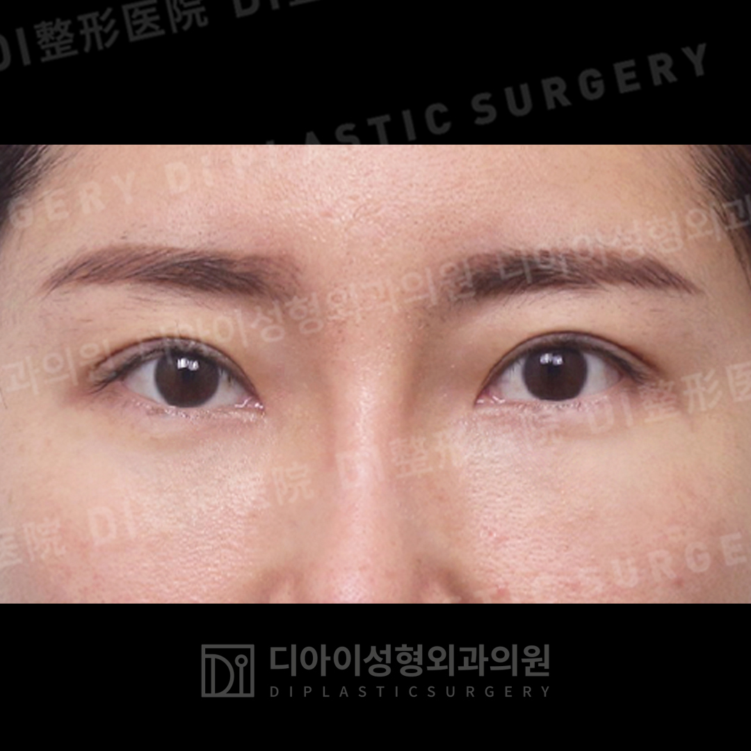 CASE 5 · After