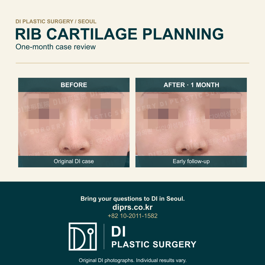 Rib Cartilage and Paranasal Augmentation in Seoul: Case 005 Planning Questions