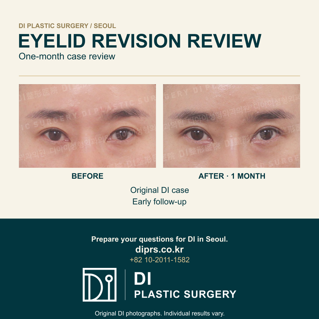 Official DI case-012, before and one-month follow-up, original clinical photographs, masking and watermark retained. Separate English labels outside the photographs. Individual results vary.
