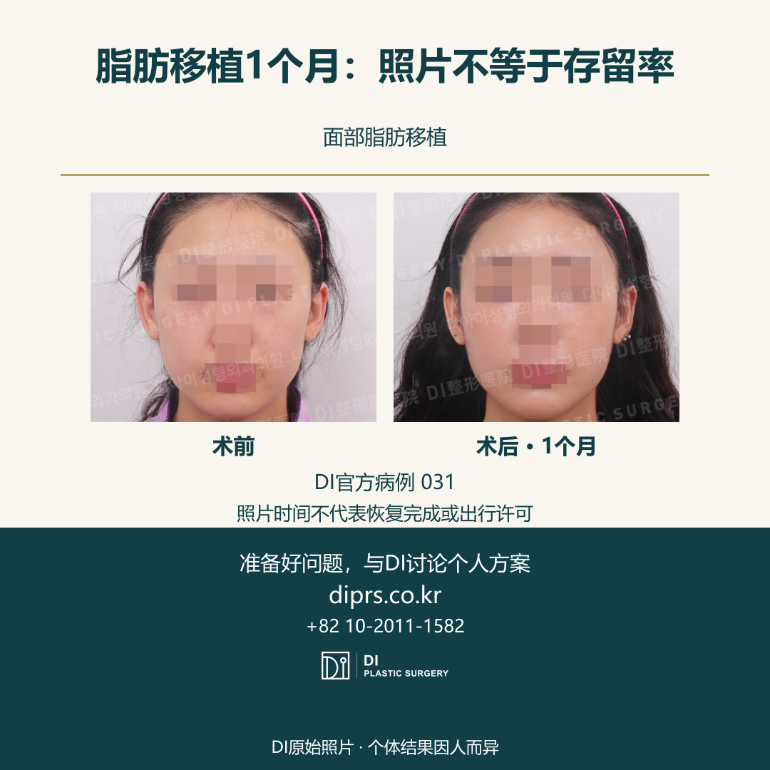 DI官方病例031术前及术后1个月原始成对照片;保留隐私遮挡和水印,中文标签位于照片之外。