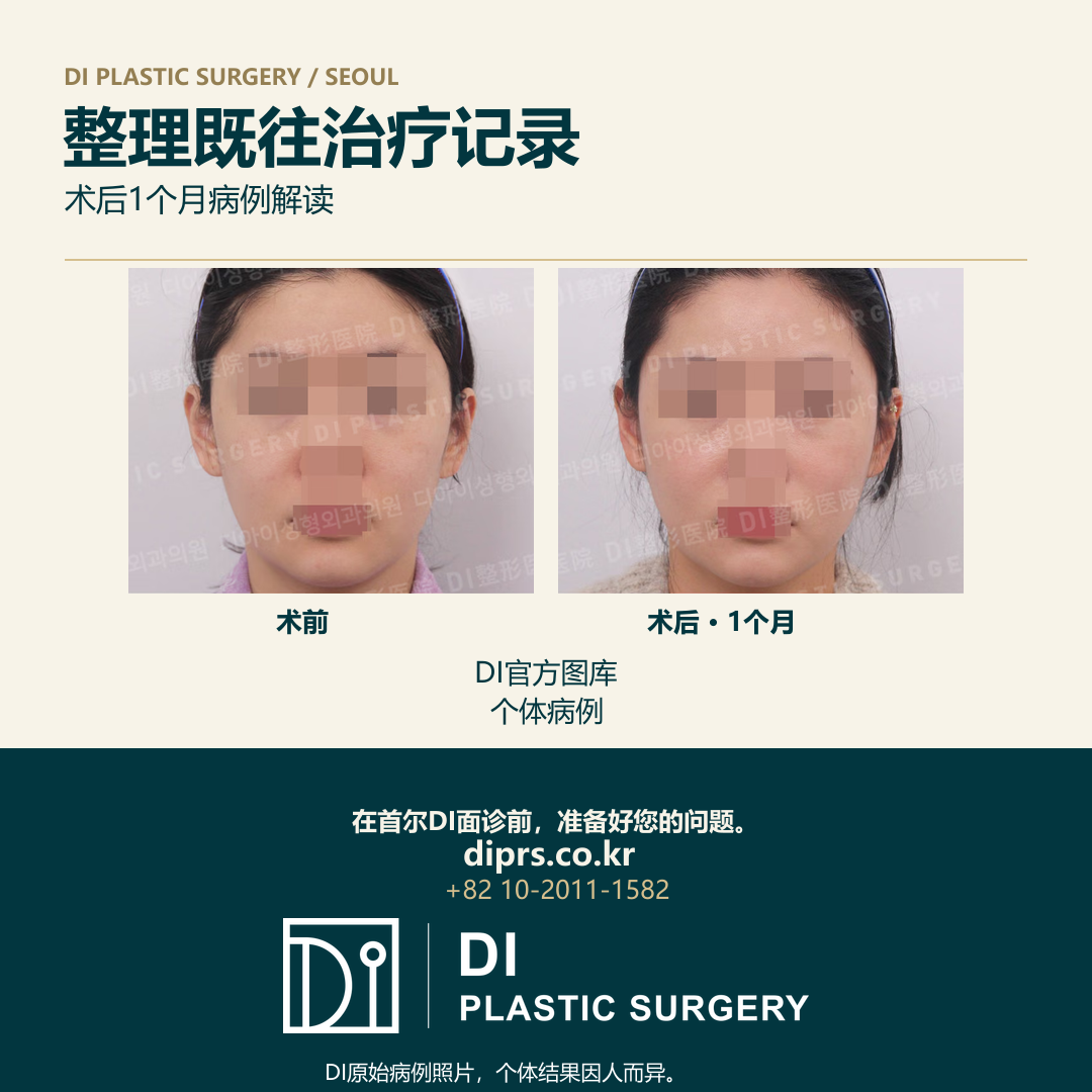DI官方病例034术前及术后1个月原始成对照片;保留隐私遮挡和水印。