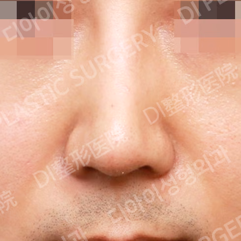 After surgery: case 063, Bulbous-nose correction, 1 month after surgery