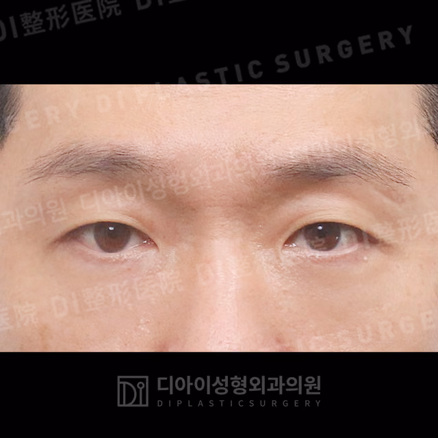 After: Under-eye fat repositioning, Front