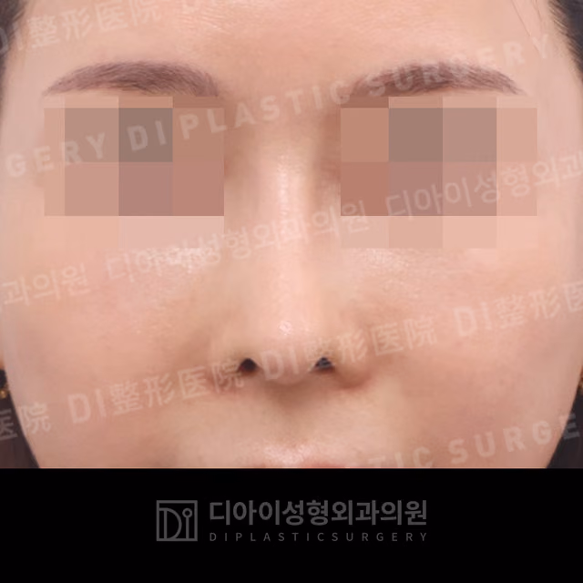After: Own rib cartilage · Revision rhinoplasty · Paranasal augmentation, Front