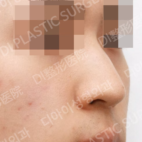斜鼻修正 · 骨切り術 · 45度 · 術前