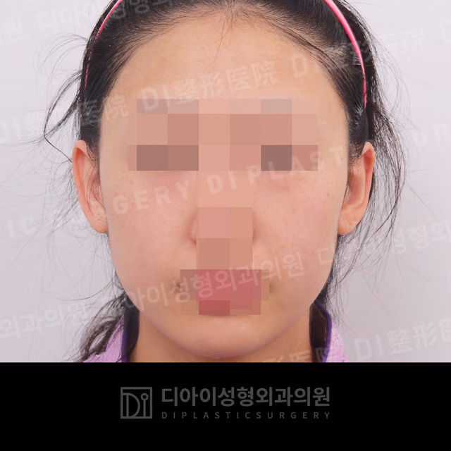 Before surgery: case 031, Fat grafting