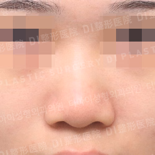 Before surgery: case 659, Low-bridge rhinoplasty · Bulbous-nose correction