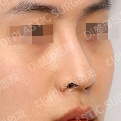 斜鼻修正 · わし鼻修正 · 45度 · 術前