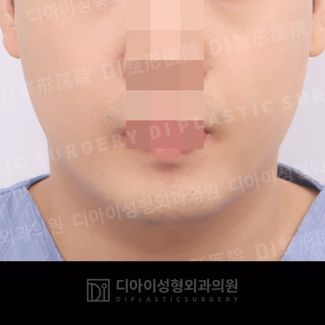 Before surgery: case 013, Double-chin liposuction