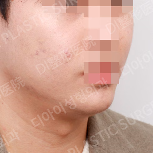 After surgery: case 130, Chin implant, 1 month after surgery