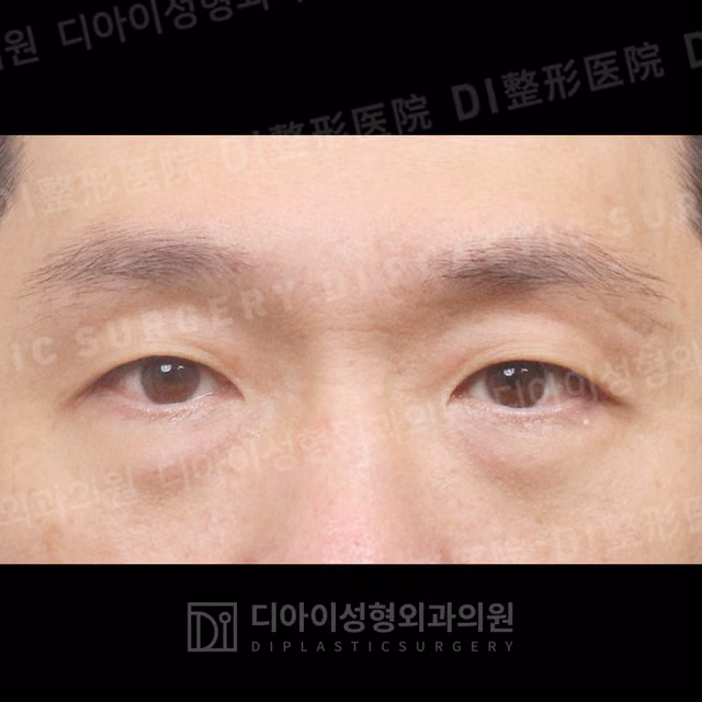 Before: Under-eye fat repositioning, Front