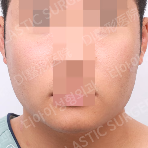 Before surgery: case 342, Square-jaw reduction