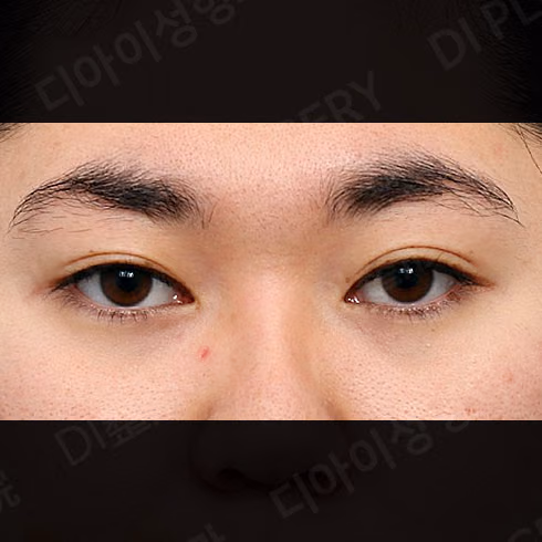 Before surgery: case 430, Natural-adhesion double-eyelid surgery · Ptosis correction