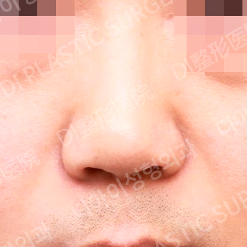 Before surgery: case 063, Bulbous-nose correction