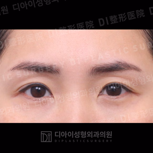 Before: Incisional double-eyelid surgery · Upper canthoplasty, Front