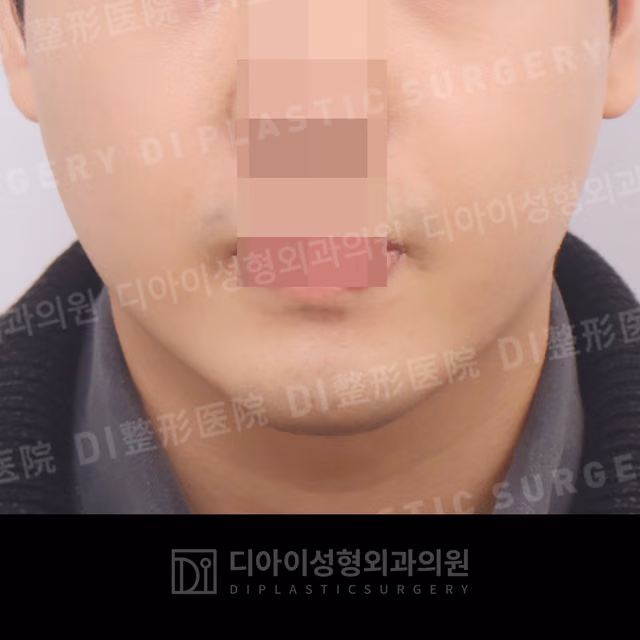 After surgery: case 013, Double-chin liposuction, 1 month after surgery