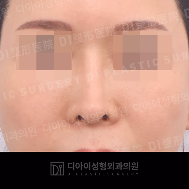 Before: Own rib cartilage · Revision rhinoplasty · Paranasal augmentation, Front
