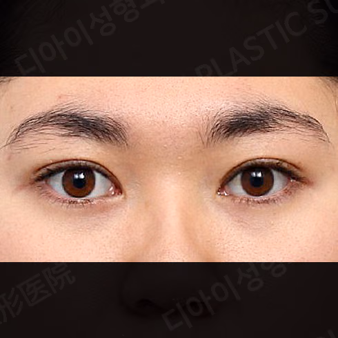 After surgery: case 430, Natural-adhesion double-eyelid surgery · Ptosis correction, 1 month after surgery