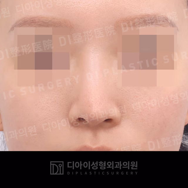 Before: Own rib cartilage · Revision rhinoplasty · Paranasal augmentation, Front