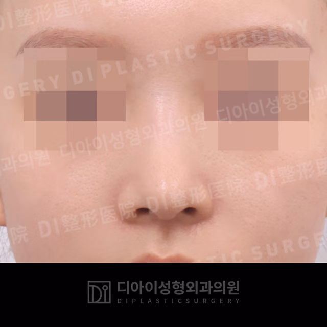 After: Own rib cartilage · Revision rhinoplasty · Paranasal augmentation, Front