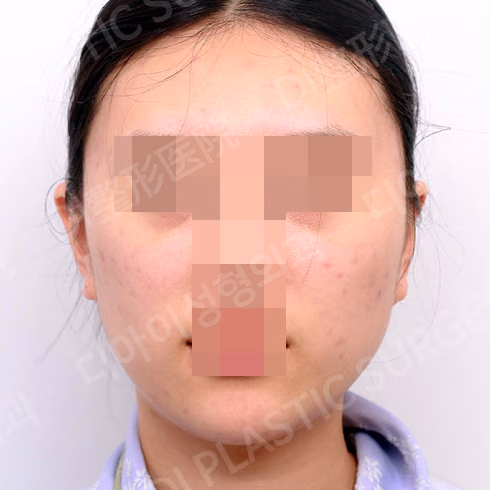 脂肪移植 · 正面 · 术前