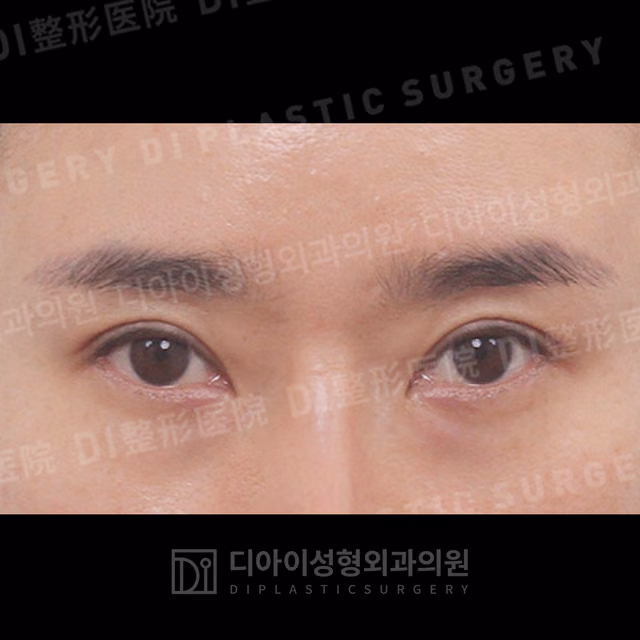 After: Incisional eyelid revision, Front
