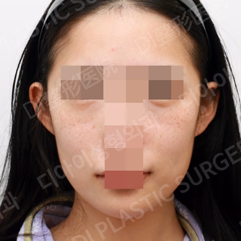 脂肪移植 · 正面 · 术前