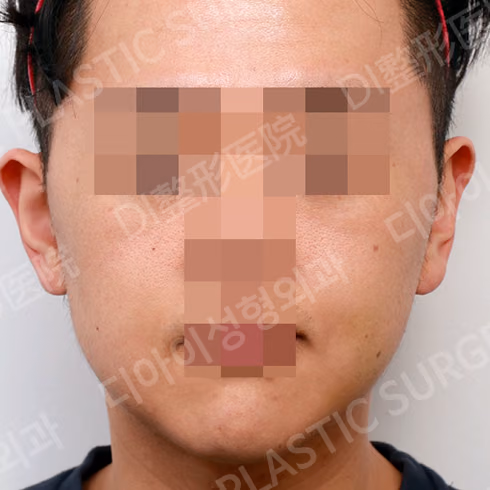 ศัลยกรรมโหนกแก้ม · ด้านหน้า · หลังทำ