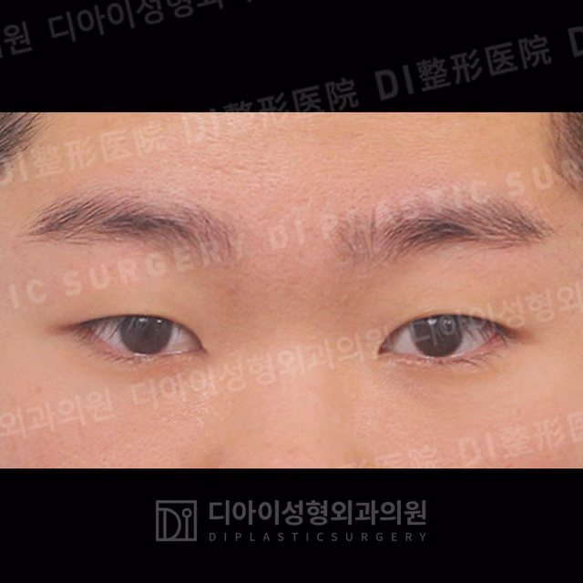 Before: Incisional double-eyelid surgery · Ptosis correction, Front