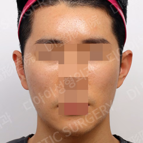 脂肪移植 · 埋线提升 · 正面 · 术后