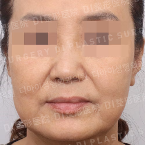 Подтяжка лица · Спереди · До