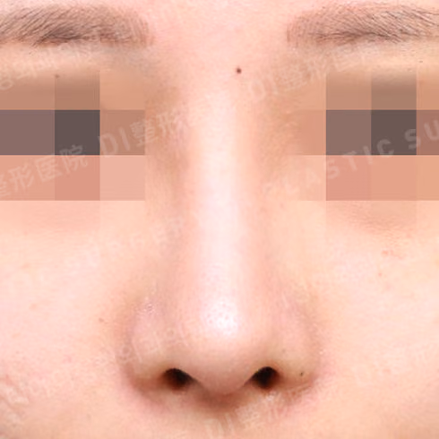 After surgery: case 678, Long-nose correction, 2 months after surgery