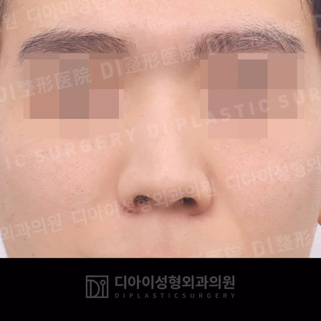 Before: Dorsal hump correction · Osteotomy · Deviated-nose correction, Front