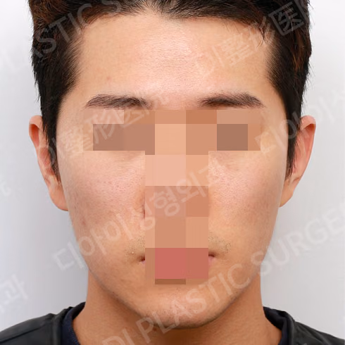 脂肪移植 · 埋线提升 · 正面 · 术前