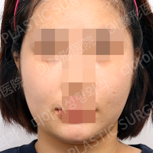 ศัลยกรรมโหนกแก้ม · ด้านหน้า · หลังทำ