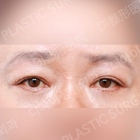 ยกกระชับใต้คิ้ว · ศัลยกรรมเปลือกตาล่าง · ด้านหน้า · หลังทำ