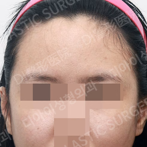 Before surgery: case 409, Forehead reduction