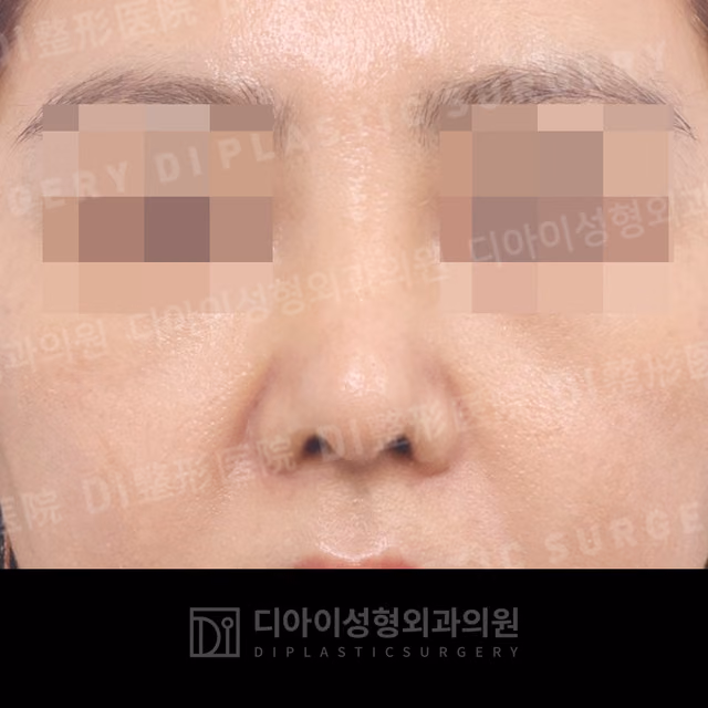 After: Own rib cartilage · Revision rhinoplasty · Short-nose correction · Paranasal augmentation, Front