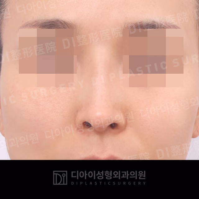 Before: Own rib cartilage · Revision rhinoplasty · Dorsal hump correction · Paranasal augmentation, Front