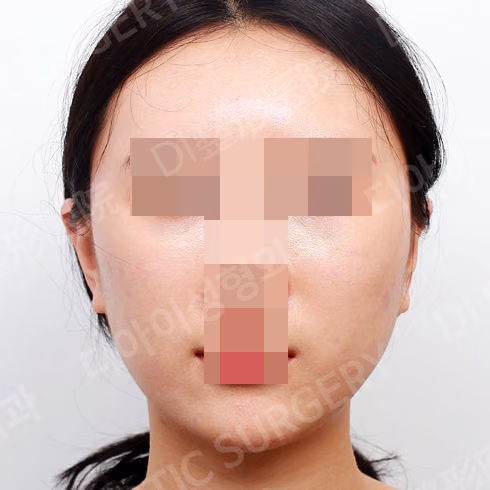 脂肪移植 · 正面 · 术后
