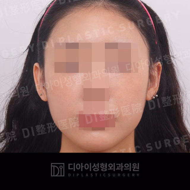 After surgery: case 031, Fat grafting, 1 month after surgery