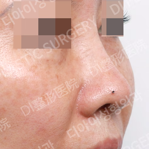 After surgery: case 529, Short-nose correction, 2 months after surgery