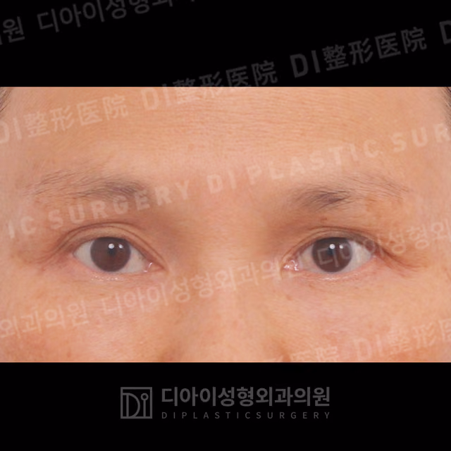 Before: Incisional eyelid revision, Front