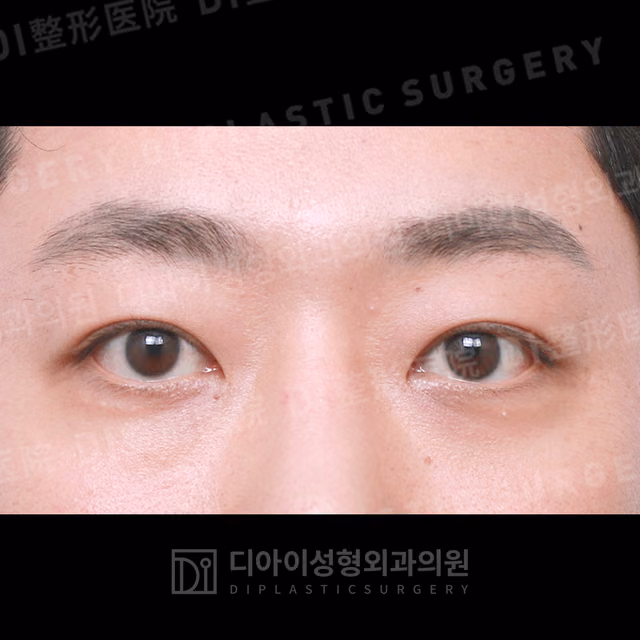 After surgery: case 277, Incisional double-eyelid surgery, 1 month after surgery